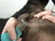 How to get rid of lice: 6 effective solutions
